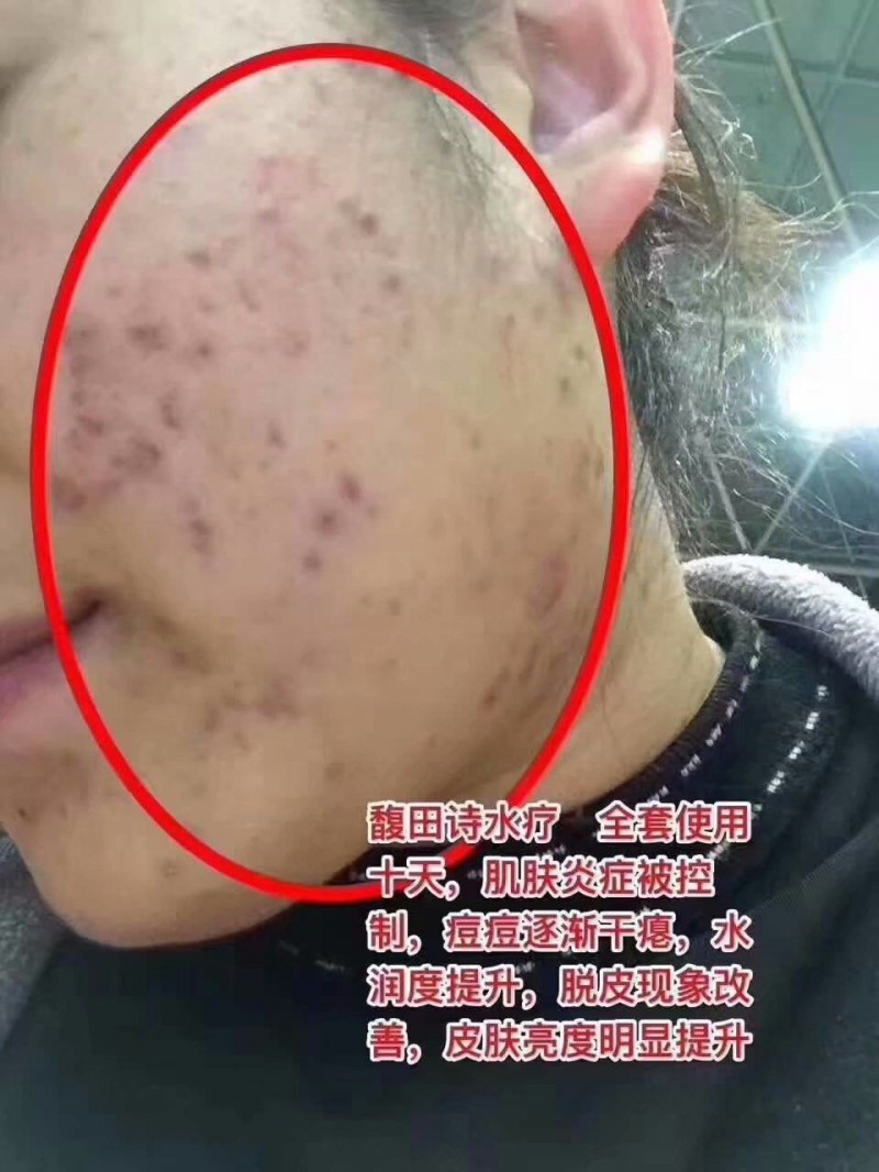 馥田詩水療，全套使用十天，肌膚炎癥被控制，痘痘逐漸干癟，水潤度提升，脫皮現(xiàn)象改善，皮膚亮度明顯提升。